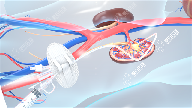 引流导管手术动画