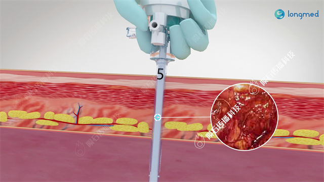 医学动画:腹腔穿刺手术动画