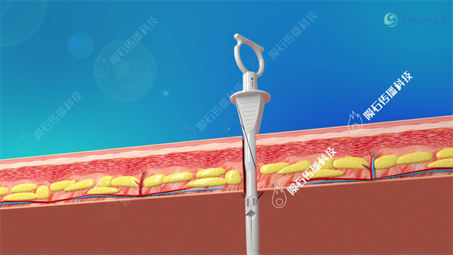 微创皮下筋膜缝合器手术动画